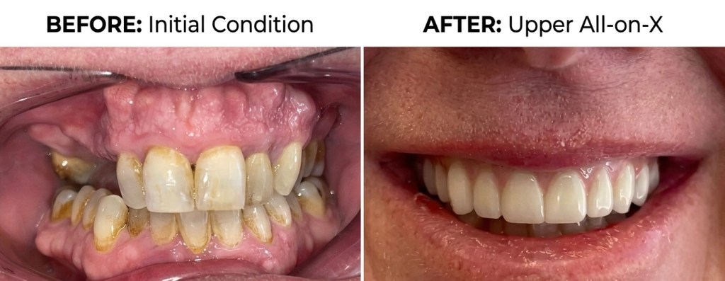 Before and after upper All-on-X smile transformation