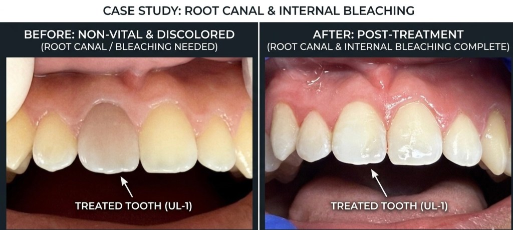 Before and after root canal treatment and internal bleaching of a discolored front tooth