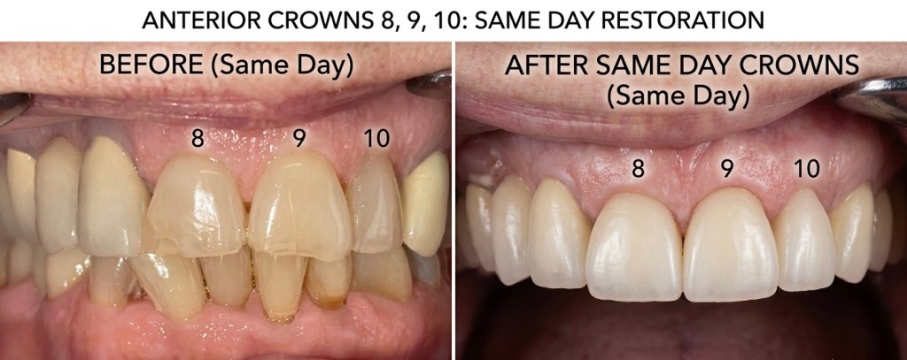 Before and after same-day crowns on upper anterior teeth 8 9 and 10