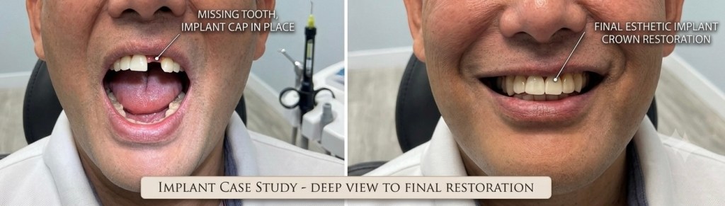 Before missing front tooth and after esthetic dental implant crown